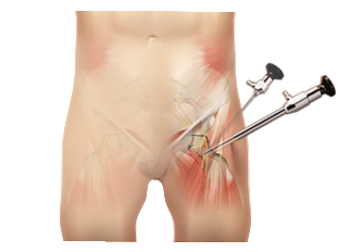  Hip Arthroscopy